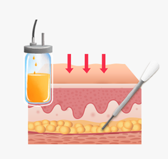 Suctioning liquefied fat cells with a cannula tube after fat layer liquefaction
