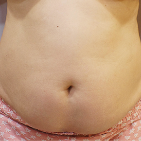 Mommy Makeover before