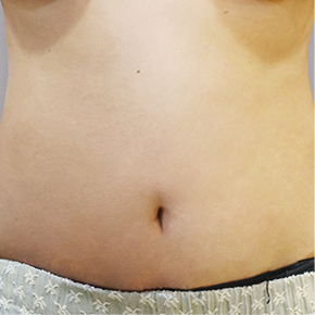 Mommy Makeover after