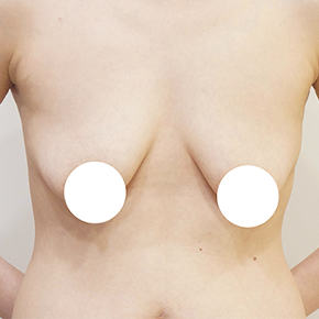 Mommy Makeover before