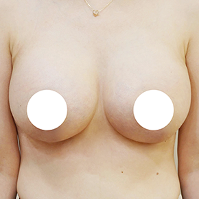 Mommy Makeover after