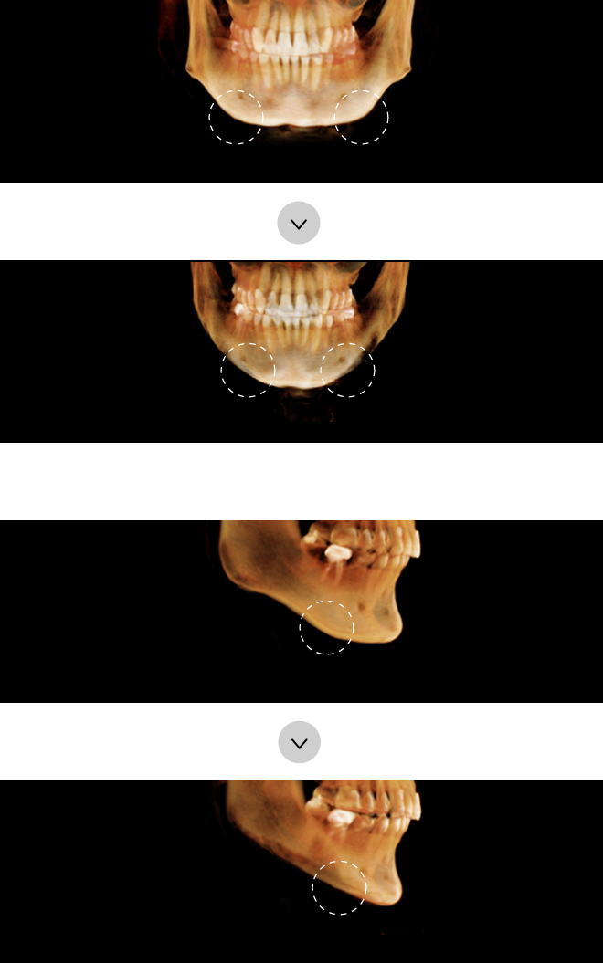 Before vs. After Mouth Corner Square Jaw Surgery