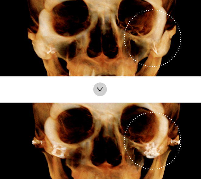 If there is no effect after cheekbone reduction surgery