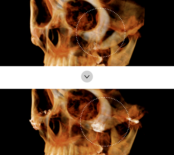 If the cheekbone is drooping and non-union after surgery