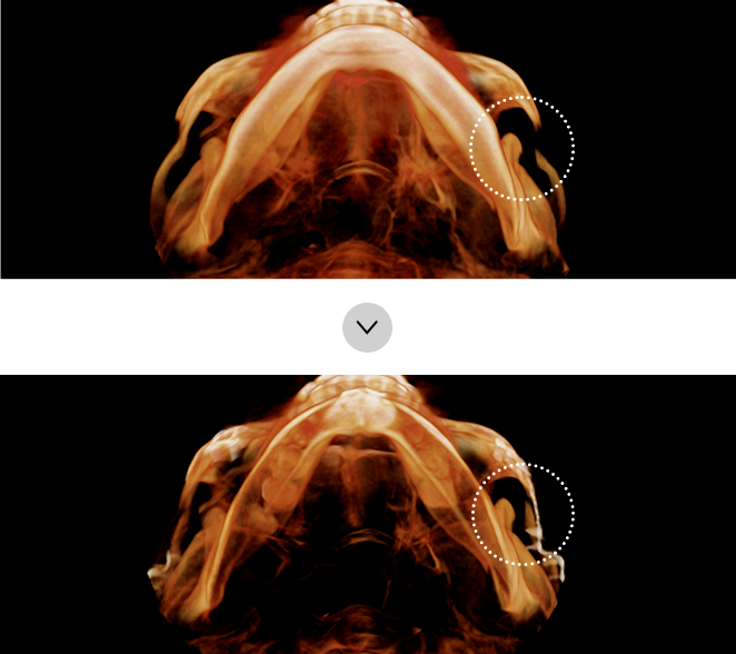 If the temple area is sunken or has a staircase effect after surgery