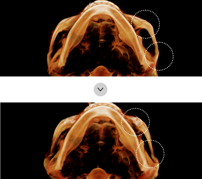 If there is asymmetry within the left and right sides of the face after surgery .