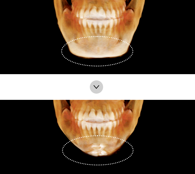 If there are no effects after square jaw reduction