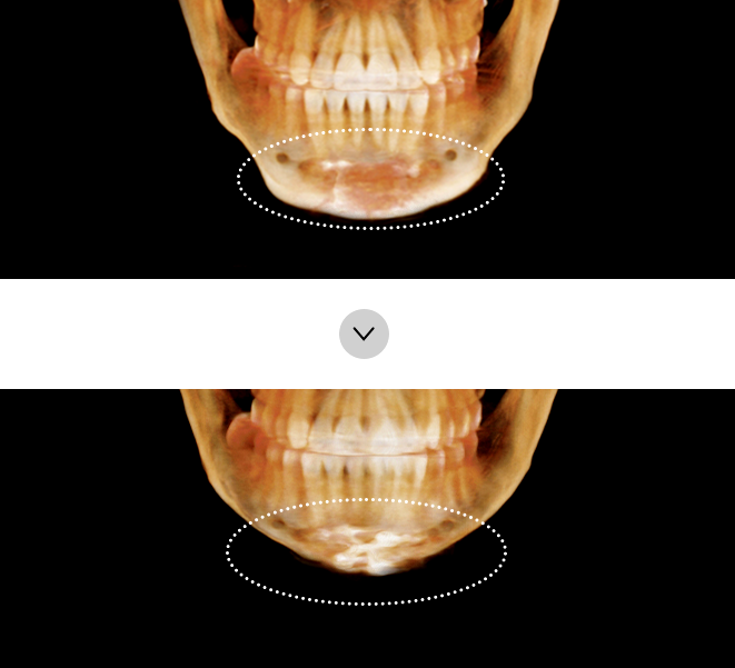 If there are no effects after square jaw surgery and genioplasty