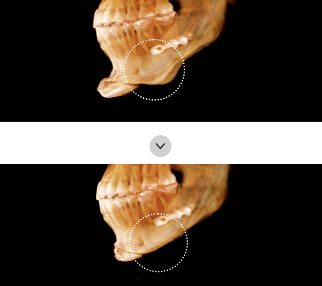 If there is a formation of secondary angle and staircase effect after surgery