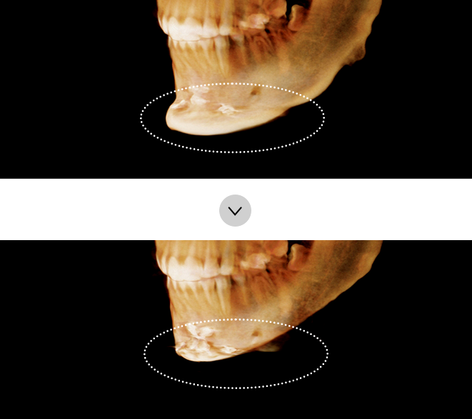 If the chin is still long and protrudes after surgery