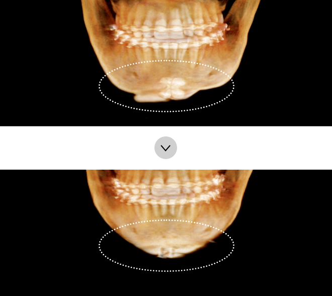 If the chin is too short after surgery