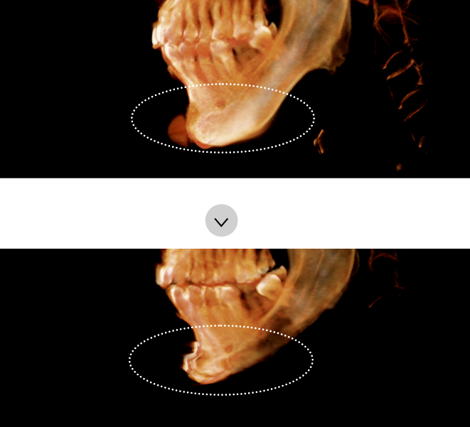 If the revision surgery is required because of complication after chin implant augmentation