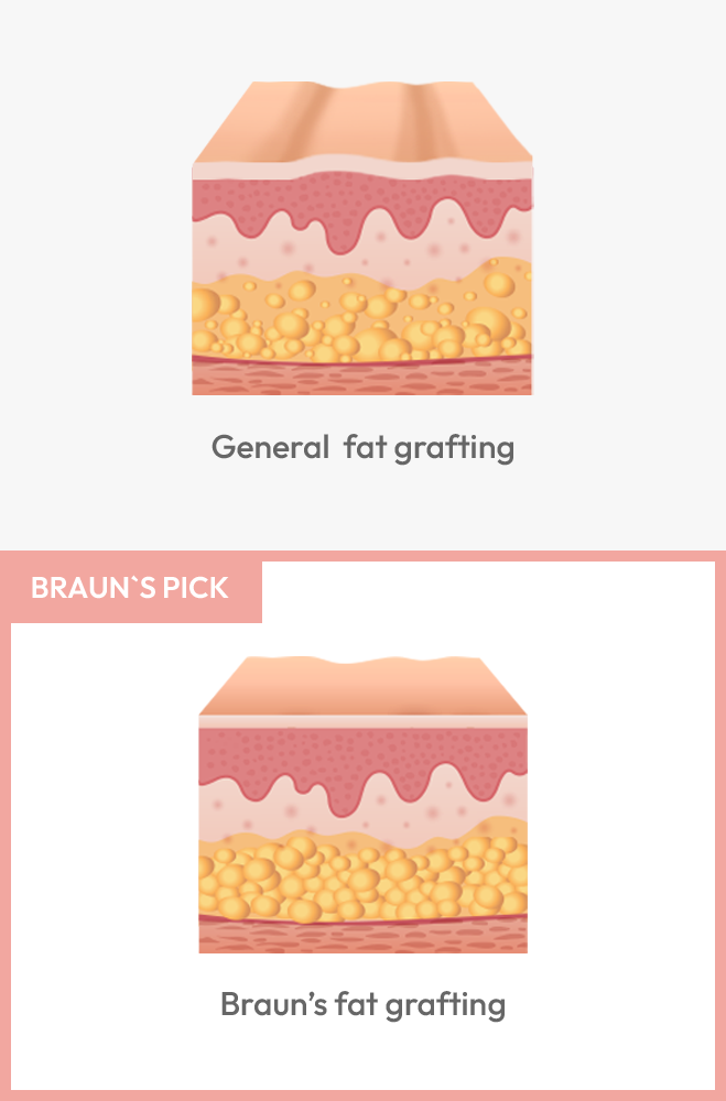 Braun's Fat Grafting Surgery