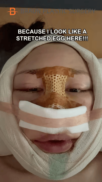 Early rhinoplasty recovery image showing nasal dressing and swelling